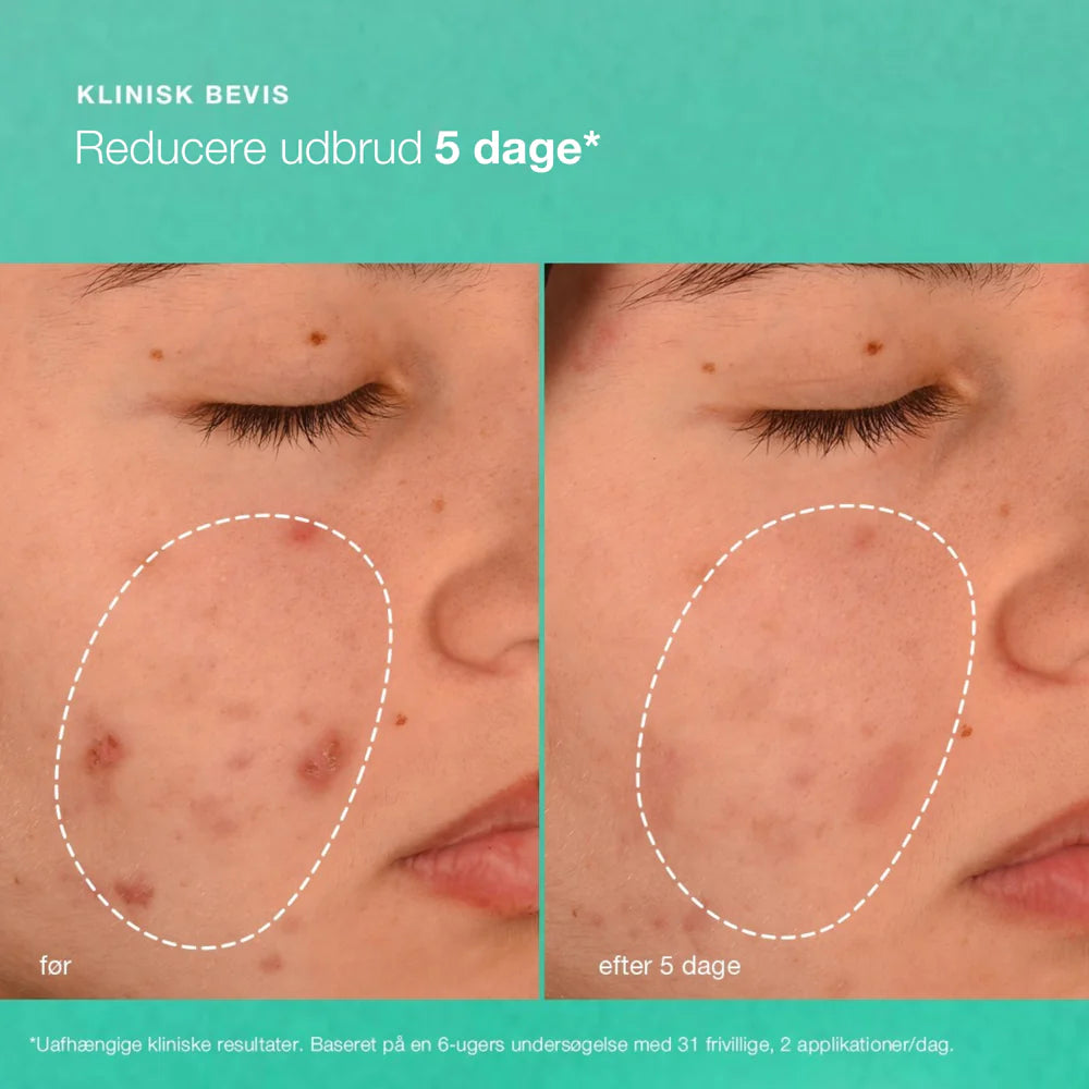 Breakout biotic moisturizer