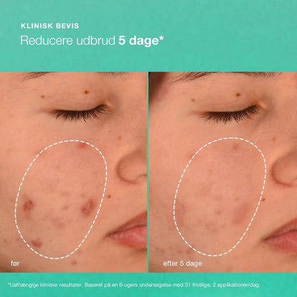 Breakout biotic moisturizer